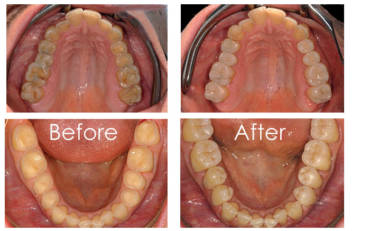 Piękny i zdrowy uśmiech na jednej wizycie? NATURALNIE!!!