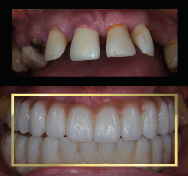 Metamorfoza uśmiechu w jeden dzień – implanty i protetyka Białystok