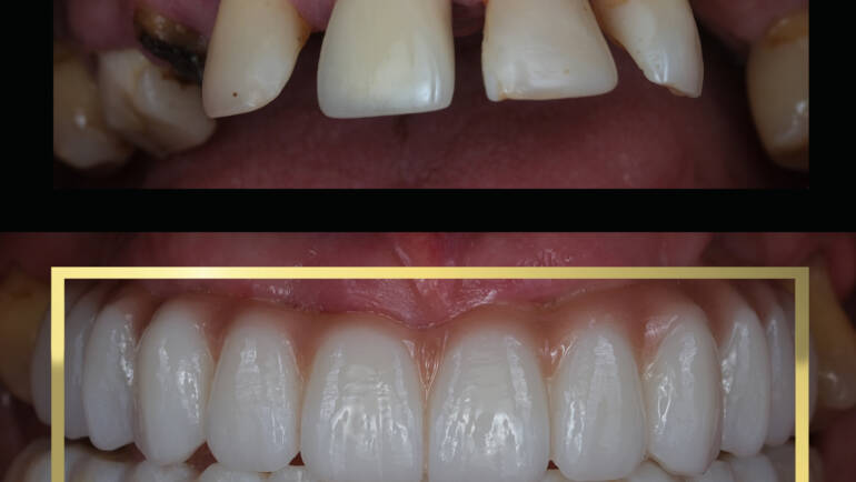 Metamorfoza uśmiechu w jeden dzień – implanty i protetyka Białystok