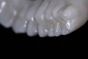 odbudowa protetyczna All-on-X