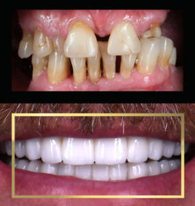 metamorfoza uśmiechu All-on-X Białystok