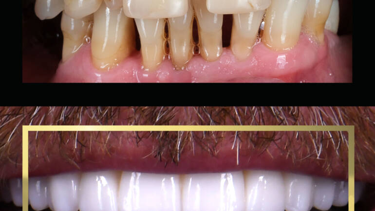 All-on-X Białystok – nowy uśmiech w jeden dzień