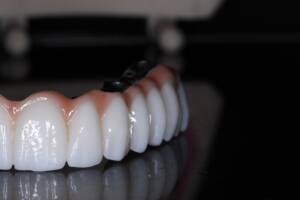 odbudowa protetyczna All-on-X