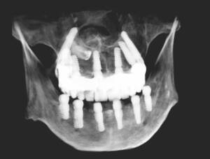 All-on-X w Białymstoku