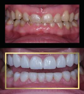 Protetyka Białystok Metamorfoza uśmiechu