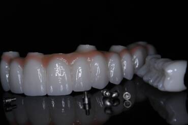 Protetyka Białystok | Metamorfoza uśmiechu w CZAR-DENT & CZAR-LAB