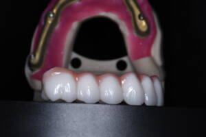 Zbliżenie na laboratoryjne detale pracy protetycznej z CZAR-LAB: frezowana belka tytanowa precyzyjnie licowana ceramiką z odtworzoną maską dziąsłową, przygotowana do osadzenia na implantach