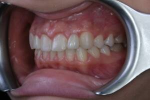 Ujęcie makro przedstawiające efekt końcowy kompleksowej metamorfozy uśmiechu Pacjentki. Zbliżenie ukazuje precyzyjną integrację estetycznego bondingu kompozytowego z naturalnie wyglądającymi koronami cyrkonowymi