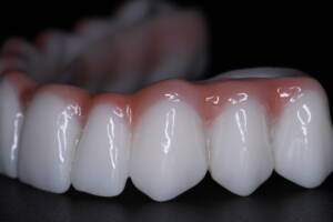 protetyka łuku zębowego wykonane w cyfrowej technologii CAD/CAM, prezentujące wytrzymałe mosty z tlenku cyrkonu