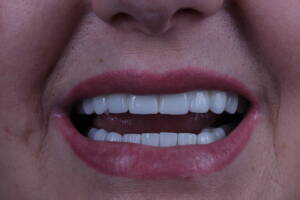 metamorfoza uśmiechu w Białymstoku - góra i dół