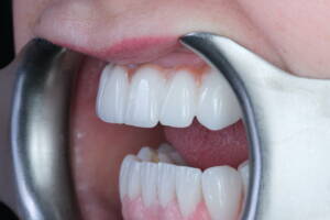 Fotografia makro detali ostatecznej odbudowy protetycznej w jamie ustnej Pacjentki. Zbliżenie na naturalną strukturę licówek i harmonijną integrację mostów cyrkonowych z tkankami miękkimi