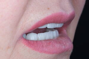 Zdjęcie macro protetyki w Białymstoku-czar-lab