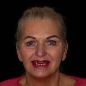 Fotografia ukazująca stan wyjściowy uśmiechu Pacjentki przed podjęciem kompleksowego leczenia implantologicznego i protetycznego w klinice CZAR-DENT