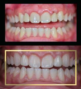 Porównanie uśmiechu przed i po kompleksowym leczeniu protetycznym. Widoczne idealnie odwzorowane korony porcelanowe osadzone na implantach zębowych w miejscu górnych dwójek, zaprojektowane we współpracy z laboratorium CZAR-LAB