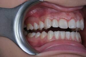 Ujęcie makro przedstawiające efekt końcowy kompleksowej metamorfozy uśmiechu Pacjentki. Zbliżenie ukazuje precyzyjną integrację estetycznego bondingu kompozytowego z naturalnie wyglądającymi koronami cyrkonowymi