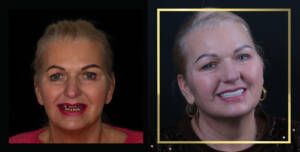 Zestawienie efektów przed i po metamorfozie uśmiechu. Ukazuje spektakularny rezultat połączenia procedury Nowy uśmiech w jeden dzień w górnym łuku z wieloetapową odbudową protetyczną dopasowaną do rysów twarzy Pacjentki