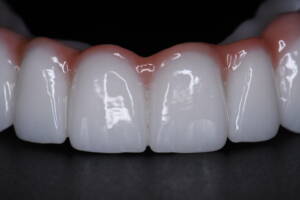 Fotografia makro detali ostatecznej odbudowy protetycznej