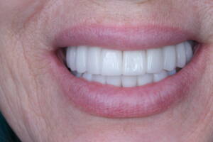 Zbliżenie makro na detale odbudowy protetycznej z tlenku cyrkonu w odcieniu 0M2. Precyzja technologii CAD/CAM w wykonaniu laboratorium CZAR-LAB i CZAR-DENT