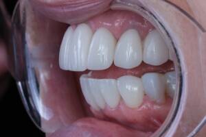 Zbliżenie makro na detale odbudowy protetycznej z tlenku cyrkonu w odcieniu 0M2. Precyzja technologii CAD/CAM w wykonaniu laboratorium CZAR-LAB i CZAR-DENT