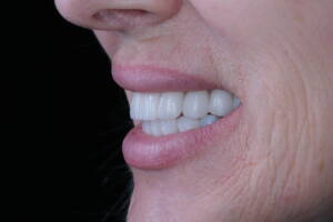 Zbliżenie makro na detale odbudowy protetycznej z tlenku cyrkonu w odcieniu 0M2. Precyzja technologii CAD/CAM w wykonaniu laboratorium CZAR-LAB i CZAR-DENT