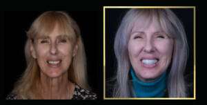 Zaawansowana odbudowa protetyczna i metamorfoza uśmiechu u Pacjenta. Efekt kompleksowej opieki specjalistycznej w klinice CZAR-DENT