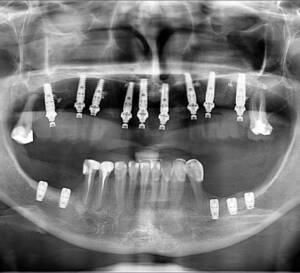 Cyfrowe zdjęcie RTG szczęki i żuchwy po wszczepieniu implantów stomatologicznych. Kompleksowa odbudowa uzębienia metodą All-on-X wykonana w Białymstoku. Nowy Uśmiech w jeden dzień