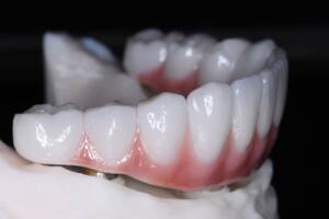 Indywidualnie wykonany most protetyczny z cyrkonu licowanego porcelaną przeznaczony do pełnej rekonstrukcji uzębienia na implantach. Naturalna estetyka i wysoka trwałość odbudowy.